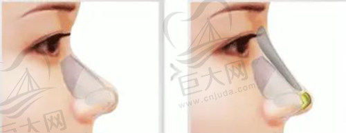 隆鼻手术 隆鼻手术