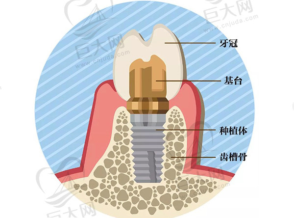 种植牙为什么那么贵？谁有正规医院种植牙收费标准2023版
