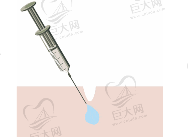 注射玻尿酸