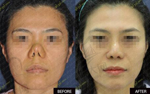 韩国4月31日整形外科医院鼻整形对比照