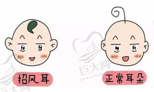 招风耳整形