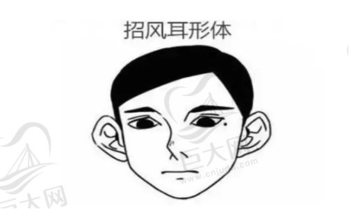 招风耳整形