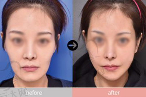 韩国VG百利酷整形外科面部轮廓手术图片