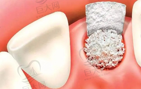 德国Dentsply Sirona 种植牙