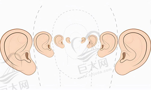 外耳廓畸形