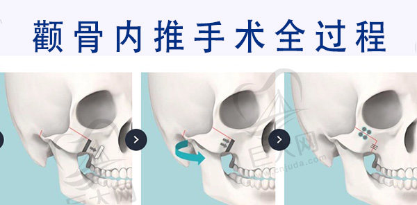 颧骨内推手术全过程分享