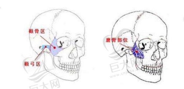 颧骨内推手术全过程分享