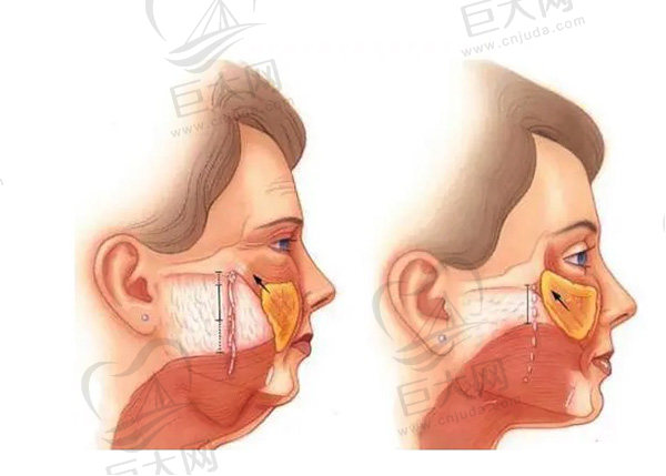 脸做拉皮手术会不会有后遗症？有人说拉皮手术几年后会老得快