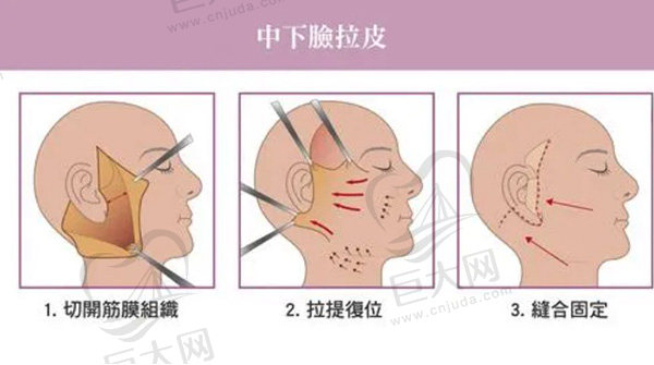 脸做拉皮手术会不会有后遗症？有人说拉皮手术几年后会老得快