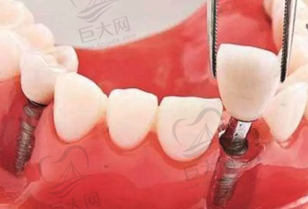 4月20日起，深圳单颗种植牙总费用降逾50%