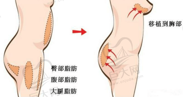 自体脂肪隆胸原理