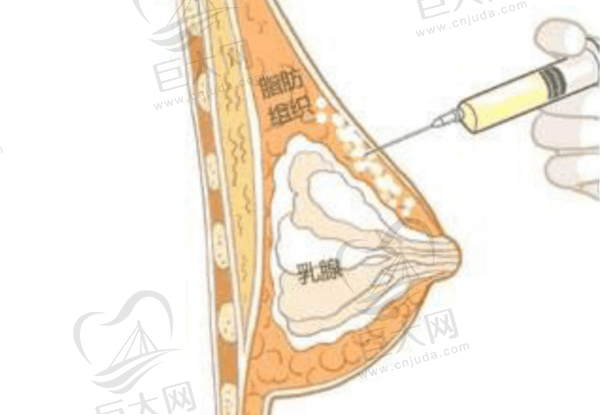 注射隆胸