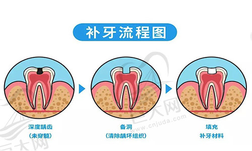 牙齿侧边有洞