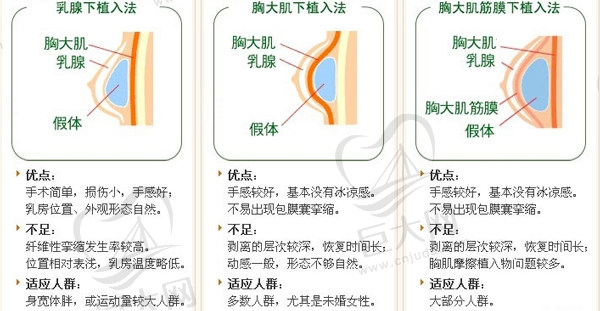 隆胸假体植入