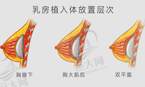 成都娇点隆胸