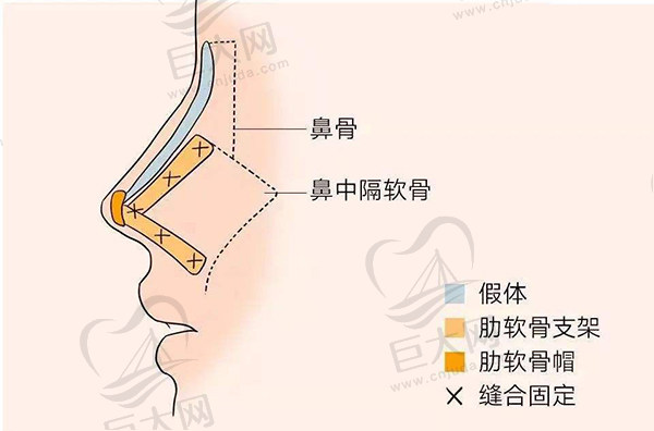 王军做鼻子的特色