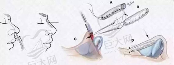 北京泛美整形医院还能做异体软骨隆鼻手术