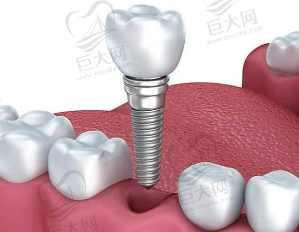 种植牙