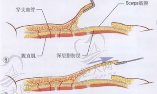 腹壁成形术