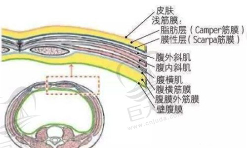 腹壁成形术