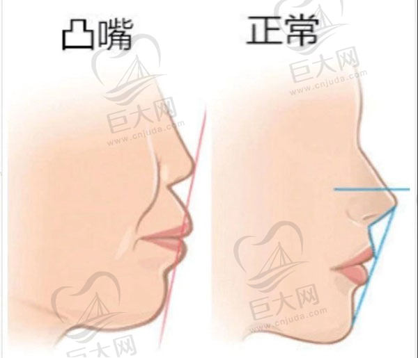 上颌骨突出