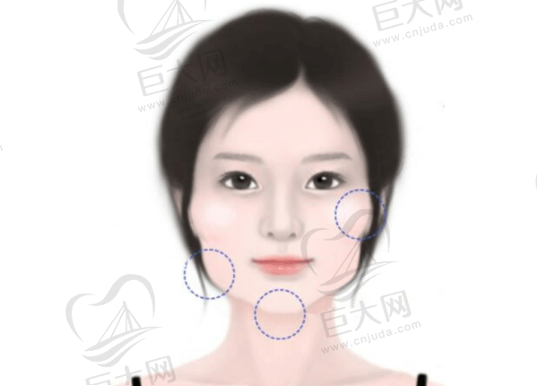 面部轮廓整形