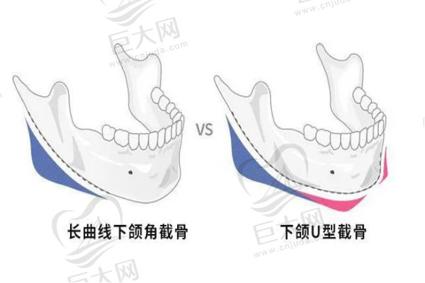 下颌角截骨示意图