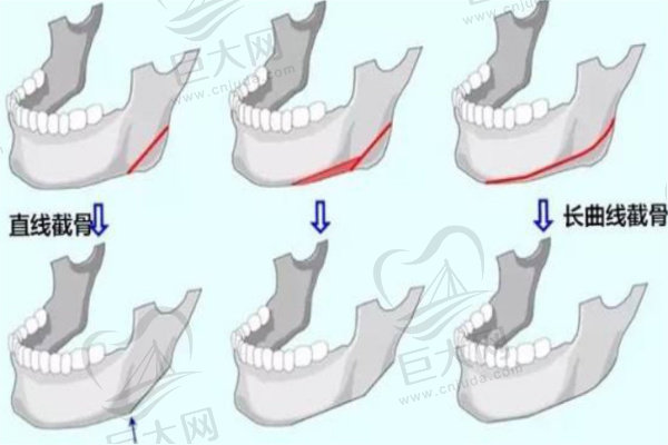 下颌角截骨不同区别