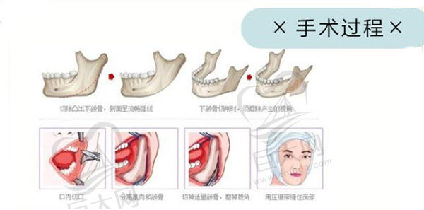 磨骨