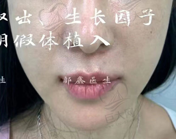 注射物取出手术要做多久