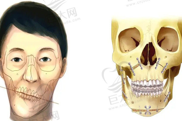 颌面手术示意图