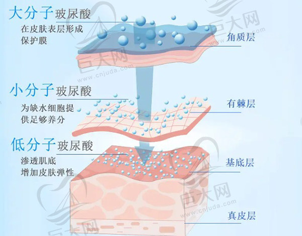 玻尿酸注射