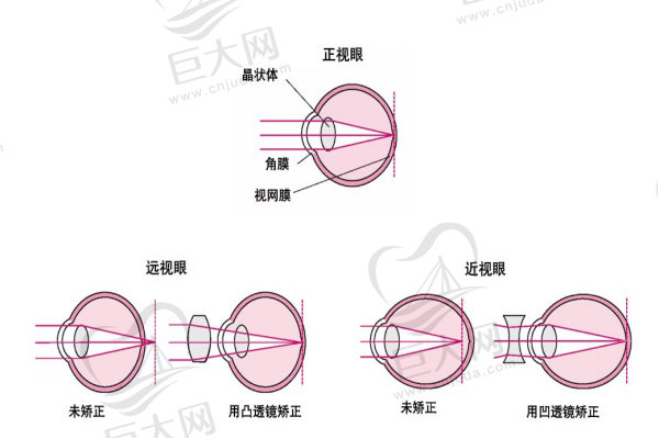 近视眼睛轴距变长