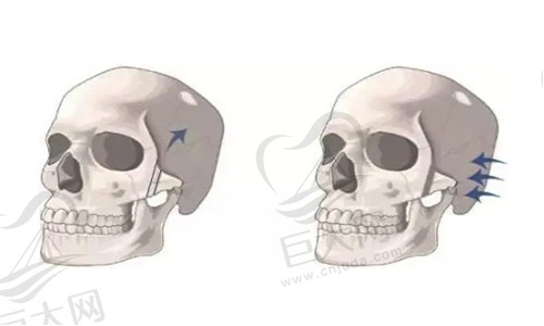 颧骨内推手术