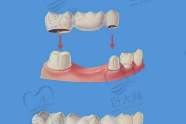 固定桥修复和种植牙哪种方式好？