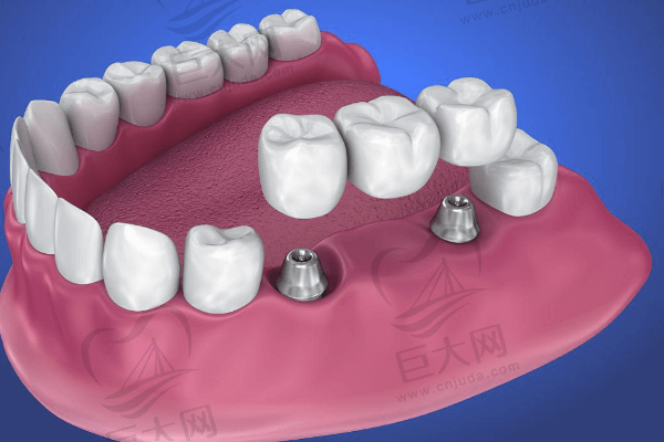 固定桥修复和种植牙哪种方式好？