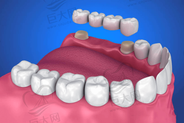 固定桥修复和种植牙哪种方式好？