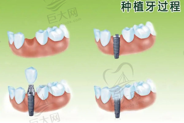种植牙示意图