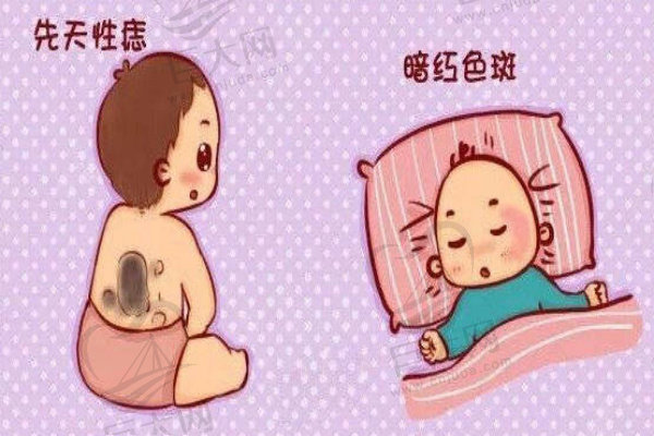 不同样式的胎记