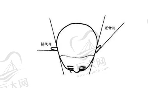 招风耳矫正