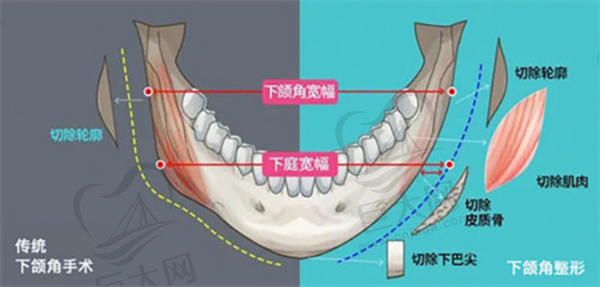 下颌角手术