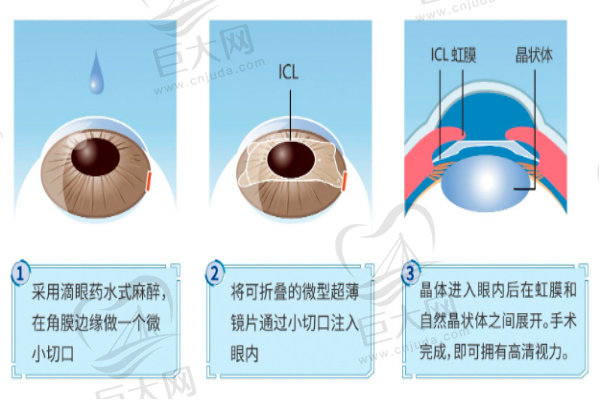 LCL晶体植入术