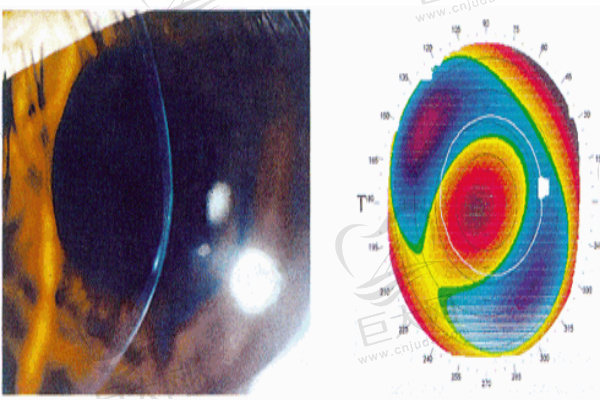眼部角膜地图