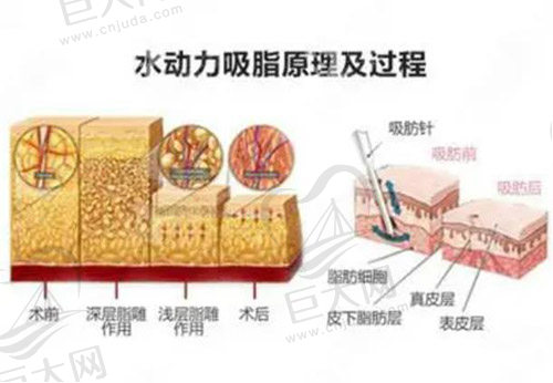 水动力吸脂的特点