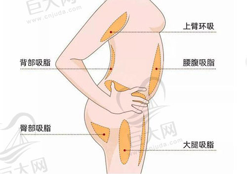 宁波吸脂整形