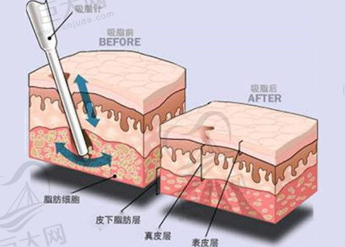 广州吸脂好的医院前十名单公布