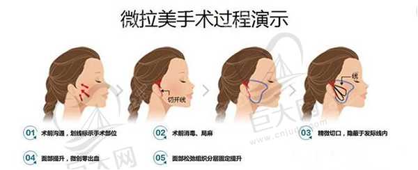 微拉美手术过程图