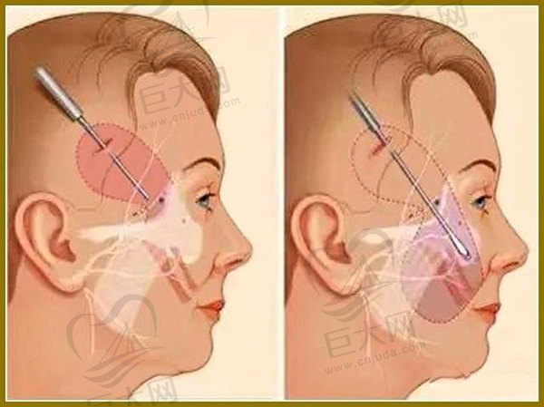 韩国faceplus整形外科拉皮手术