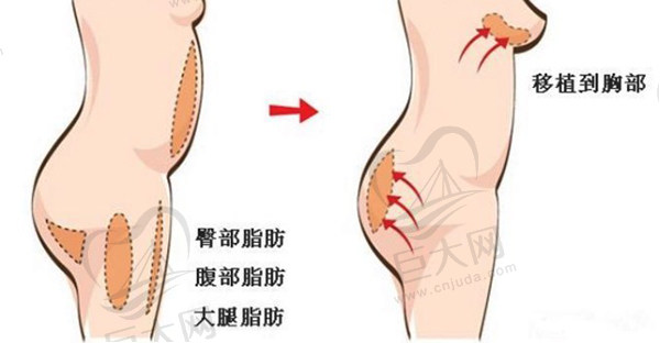 我做自体脂肪丰胸后悔了