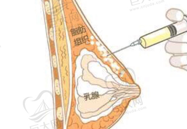 我做自体脂肪丰胸后悔了